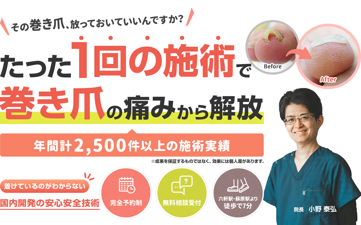 たった1回の施術で巻き爪の痛みから解放