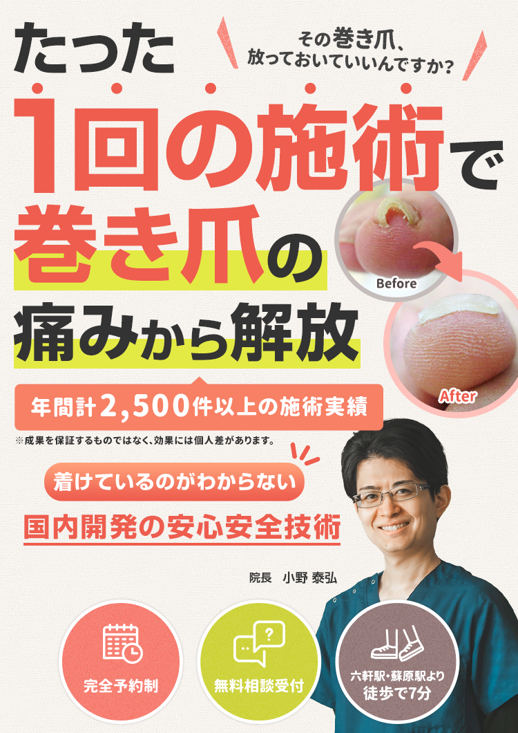 たった1回の施術で巻き爪の痛みから解放
